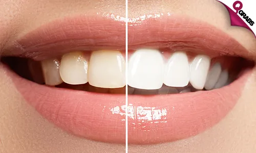 In-Office Zoom Teeth Whitening!
